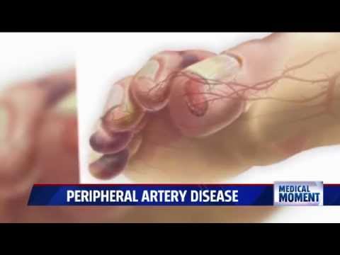 Peripheral Artery Disease: Symptoms, Causes, and Treatments