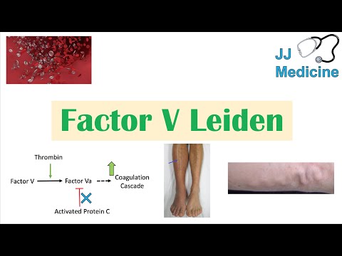 Factor V Leiden: A Key Cause of Blood Clots Explained