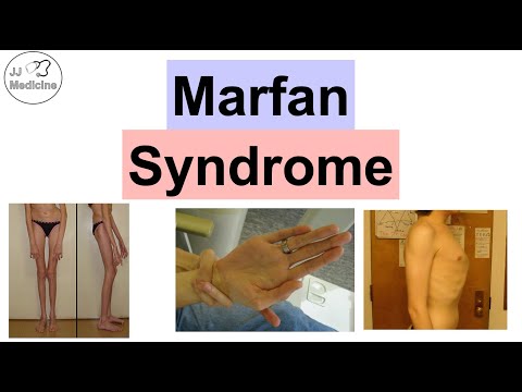 Marfan Syndrome: Understanding Its Symptoms and Management