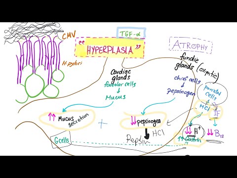Menetrier Disease: Causes, Symptoms, and Treatment Options