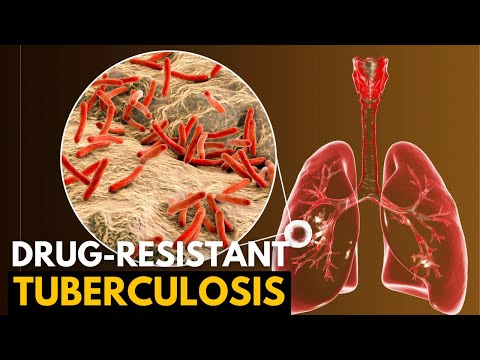 TB Disease: Symptoms, Treatment, and Preventive Measures