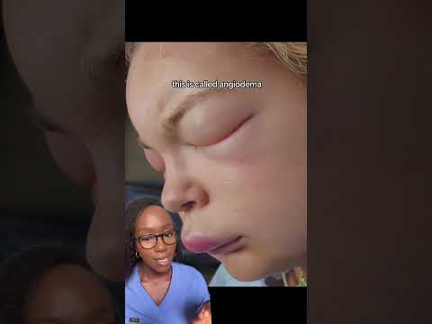 Effective Hives Treatment for Skin Relief and Comfort