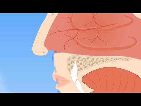 Understanding the Causes and Relief for Runny Nose