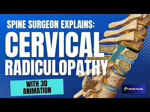 Cervical Radiculopathy: Symptoms, Causes, and Treatment Options