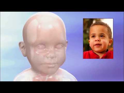 Hunter Syndrome: Symptoms, Causes, and Treatment Options