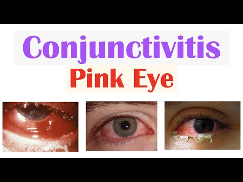 Allergic Conjunctivitis: Symptoms, Causes, and Treatment Options