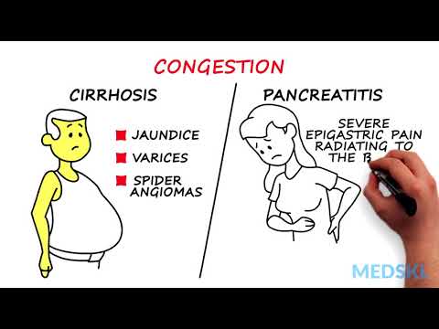 Causes of Splenomegaly: Key Factors Explained