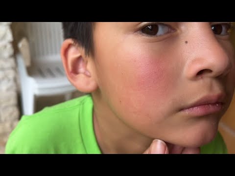 Fifth Disease Rash: Symptoms, Causes, and Treatment Options