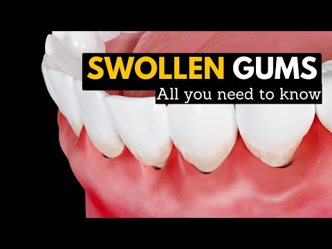 Gum Swelling: Causes, Symptoms, and Treatment Options