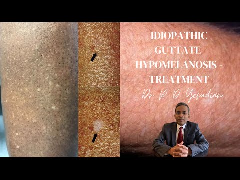 Understanding Idiopathic Guttate Hypomelanosis: Causes and Treatment