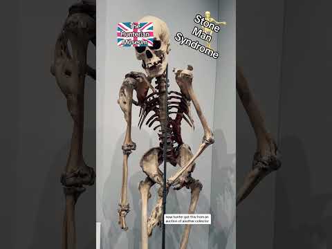 Stone Man Syndrome: A Closer Look at Its Causes and Effects