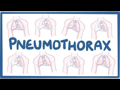 Pneumothorax Symptoms: Recognizing the Warning Signs