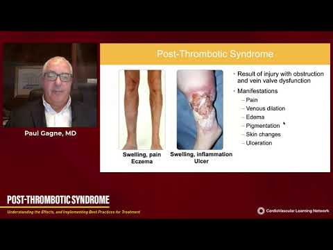Post Thrombotic Syndrome: Symptoms and Management Strategies