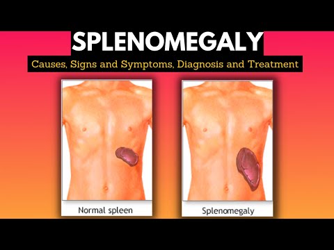 Enlarged Spleen: Symptoms, Causes, and Treatment Options