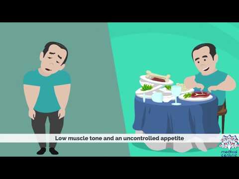 Prader-Willi Syndrome: Key Facts and Insights