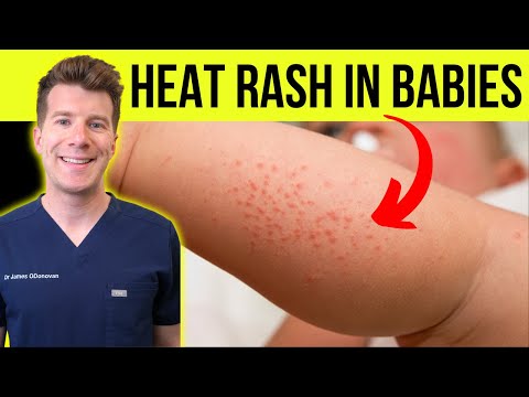 Heat Rash Symptoms: Recognizing the Signs and Causes