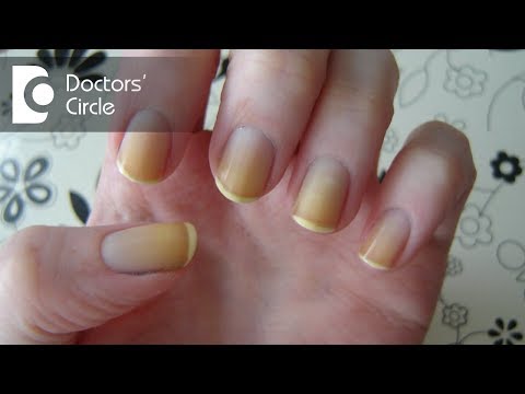 Yellow Nail Syndrome: Causes, Symptoms, and Treatments
