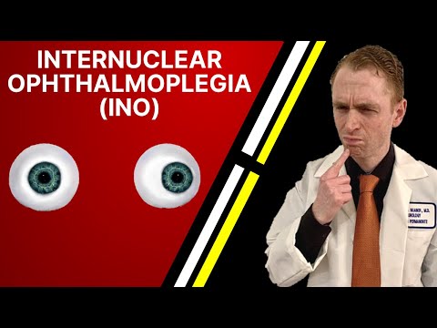 Ophthalmoplegia: Causes, Symptoms, and Treatment Options