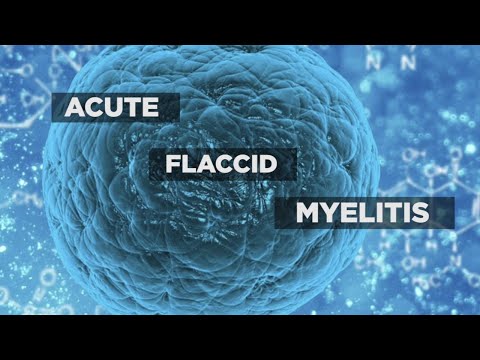 Acute Flaccid Myelitis: Causes, Symptoms, and Treatment Options