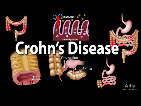 Crohn's Disease Cause: Factors and Triggers Explained