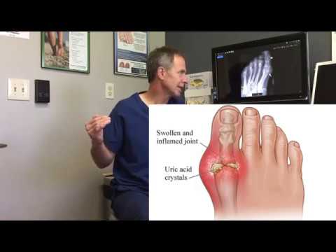 Gout on Top of Foot: Causes, Symptoms, and Treatment Options