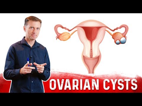 Signs of Ovarian Cysts: Know the Symptoms Early
