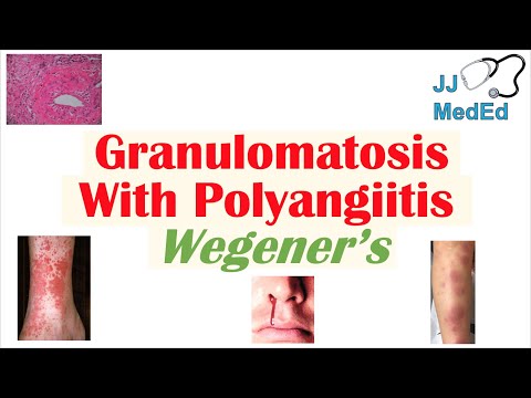 Granulomatosis: Understanding Its Causes and Treatments