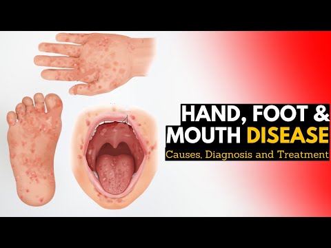 Hand Foot Mouth Disease Caused by Virus: Key Insights