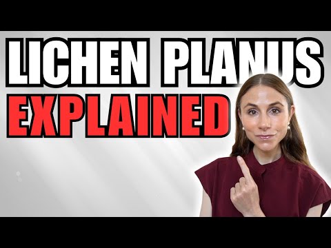 Lichen Planus Triggered by Stress: Understanding the Connection