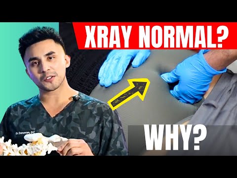 Understanding Tailbone Injury: Causes, Symptoms, and Recovery