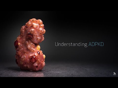 Autosomal Dominant Polycystic Kidney Disease: Key Facts and Insights